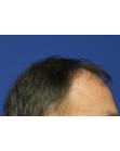 Before Hair Transplant&nbsp;Front